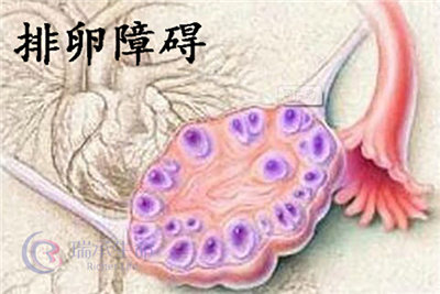 面对排卵障碍，试管婴儿有哪些科学助孕方案？