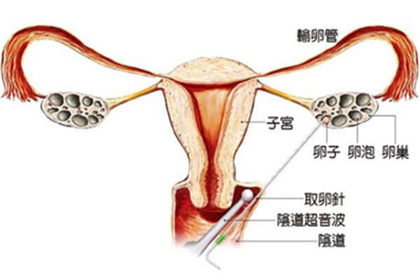 做试管婴儿前必知的黄金指南：揭秘影响取卵数量与质量的关键因素