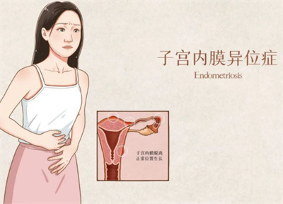 子宫内膜异位症导致不孕的几率有多大？可以做试管婴儿吗？