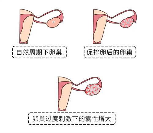 试管婴儿成功的基础：提高卵子质量很重要！