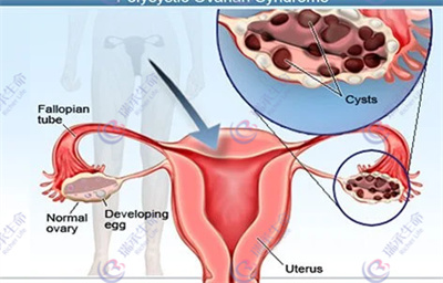 卵巢巧克力囊肿能做试管婴儿吗？成功率如何？