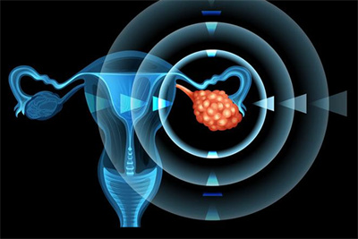 如何规避试管助孕周期中的大敌——卵巢过度刺激综合征