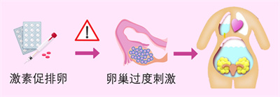 做试管的促排用药会导致肥胖吗？如何打造安全高效周期