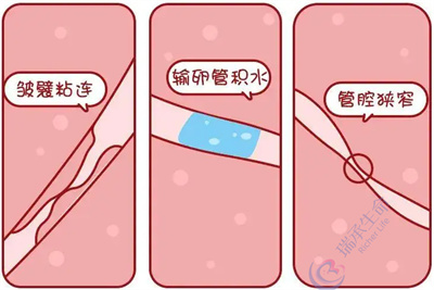 女性输卵管粘连能通过试管技术正常怀孕吗？