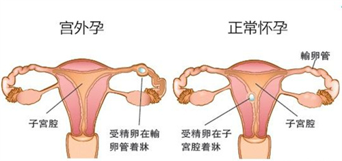 胚胎移植后出血怎么办？先别慌！