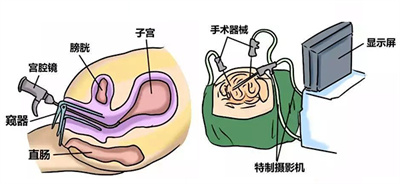 习惯性流产，找到病因才是关键！