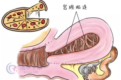 宫腔粘连可以做试管婴儿吗？试管之路的“隐形障碍”与“突破策略”