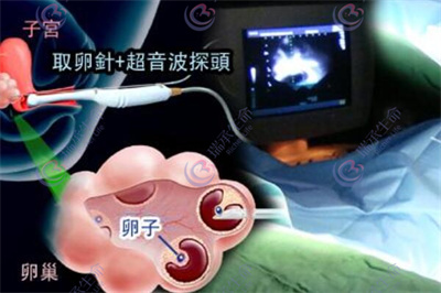 黄体功能不足怎么办?做试管婴儿能成功吗?